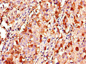 Immunohistochemistry of paraffin-embedded human lung cancer using KL Antibody at dilution of 1:100