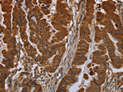 The image on the left is immunohistochemistry of paraffin-embedded Human esophagus cancer tissue using the antibody Antibody) at dilution 1/40, on the right is treated with synthetic peptide. (Original magnification: ×200)Rabbit anti-Human NPRL2 Polyclonal Antibody