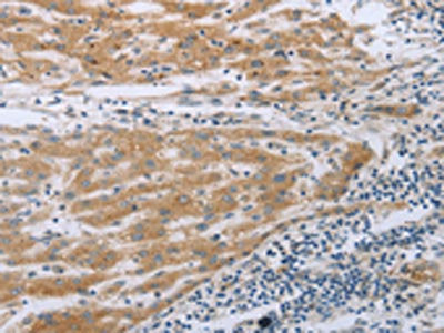 The image on the left is immunohistochemistry of paraffin-embedded Human liver cancer tissue using TNK2 Antibody(TNK2 Antibody) at dilution 1/70, on the right is treated with synthetic peptide. (Original magnification: ×200)Rabbit anti-Human TNK2 Polyclonal Antibody