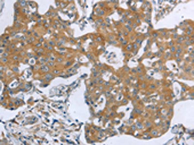 The image on the left is immunohistochemistry of paraffin-embedded Human breast cancer tissue using the antibody Antibody) at dilution 1/70, on the right is treated with synthetic peptide. (Original magnification: ×200)Rabbit anti-Human TNK2 Polyclonal Antibody