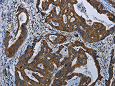 The image on the left is immunohistochemistry of paraffin-embedded Human gastric cancer tissue using COX6B2 Antibody(COX6B2 Antibody) at dilution 1/35, on the right is treated with fusion protein. (Original magnification: ×200)Rabbit anti-Human COX6B2 Polyclonal Antibody