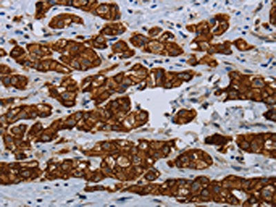 The image on the left is immunohistochemistry of paraffin-embedded Human breast cancer tissue using the antibody Antibody) at dilution 1/35, on the right is treated with fusion protein. (Original magnification: ×200)Rabbit anti-Human COX6B2 Polyclonal Antibody