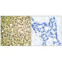 Immunohistochemical analysis of paraffin-embedded human breast carcinoma tissue using Retinoic Acid Receptor β antibody.Rabbit anti-Human RARB Polyclonal Antibody