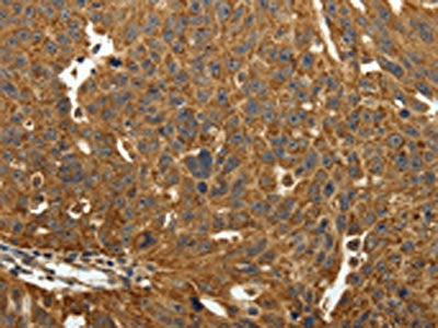 The image on the left is immunohistochemistry of paraffin-embedded Human ovarian cancer tissue using COQ3 Antibody(EIF2AK3 Antibody) at dilution 1/40, on the right is treated with fusion protein. (Original magnification: ×200)Rabbit anti-Human COQ3 Polyclonal Antibody