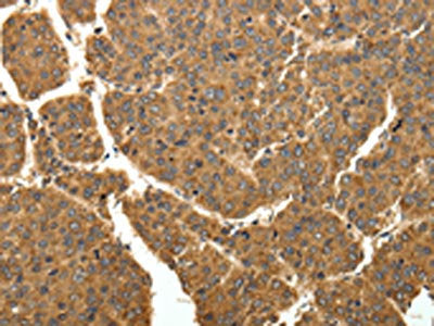 The image on the left is immunohistochemistry of paraffin-embedded Human liver cancer tissue using the antibody Antibody) at dilution 1/40, on the right is treated with fusion protein. (Original magnification: ×200)Rabbit anti-Human COQ3 Polyclonal Antibody