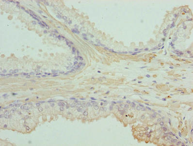Immunohistochemistry of paraffin-embedded human prostate cancer using ACTG2 Antibody at dilution of 1:100