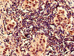 Immunocytochemistry analysis of human bladder cancer using the antibody at dilution of 1:100Rabbit anti-Human HIF1A Polyclonal Antibody