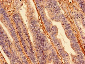 Immunocytochemistry analysis of human colon cancer using HIF1A Antibody at dilution of 1:100Rabbit anti-Human HIF1A Polyclonal Antibody