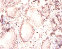 Immunohistochemistry of paraffin-embedded human prostate tissue using FGF2 Antibody at dilution of 1:100Rabbit anti-Human FGF2 Polyclonal Antibody