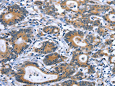 The image on the left is immunohistochemistry of paraffin-embedded Human colon cancer tissue using IBSP Antibody(IBSP Antibody) at dilution 1/30, on the right is treated with synthetic peptide. (Original magnification: ×200)Rabbit anti-Human IBSP Polyclonal Antibody