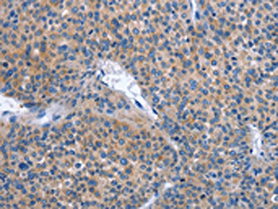 The image on the left is immunohistochemistry of paraffin-embedded Human liver cancer tissue using the antibody Antibody) at dilution 1/30, on the right is treated with synthetic peptide. (Original magnification: ×200)Rabbit anti-Human IBSP Polyclonal Antibody
