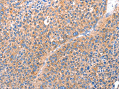 The image on the left is immunohistochemistry of paraffin-embedded Human liver cancer tissue using ACADS Antibody(ACADS Antibody) at dilution 1/15, on the right is treated with fusion protein. (Original magnification: ×200)