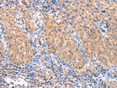 The image on the left is immunohistochemistry of paraffin-embedded Human cervical cancer tissue using the antibody Antibody) at dilution 1/15, on the right is treated with fusion protein. (Original magnification: ×200)