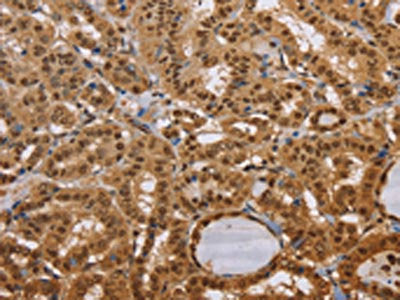 The image on the left is immunohistochemistry of paraffin-embedded Human thyroid cancer tissue using CEL Antibody(CEL Antibody) at dilution 1/40, on the right is treated with synthetic peptide. (Original magnification: ×200)Rabbit anti-Human CEL Polyclonal Antibody