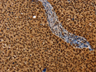 The image on the left is immunohistochemistry of paraffin-embedded Human cervical cancer tissue using the antibody Antibody) at dilution 1/40, on the right is treated with synthetic peptide. (Original magnification: ×200)Rabbit anti-Human CEL Polyclonal Antibody