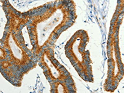 The image on the left is immunohistochemistry of paraffin-embedded Human colon cancer tissue using BCAT2 Antibody(BCAT2 Antibody) at dilution 1/50, on the right is treated with fusion protein. (Original magnification: ×200)