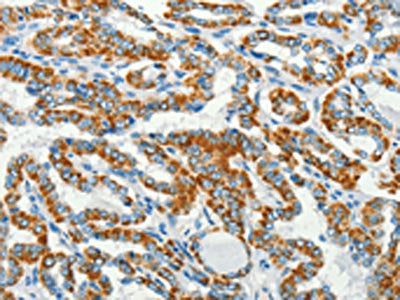 The image on the left is immunohistochemistry of paraffin-embedded Human thyroid cancer tissue using the antibody Antibody) at dilution 1/50, on the right is treated with fusion protein. (Original magnification: ×200)