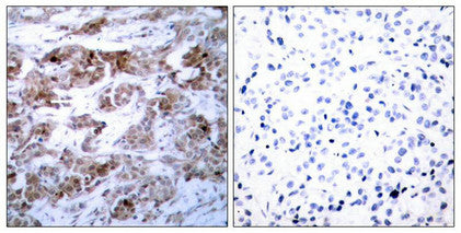 Immunohistochemical analysis of paraffin-embedded human breast carcinoma tissue using BCL-2(Ab-70) Antibody(left) or the same antibody preincubated with blocking peptide(right).