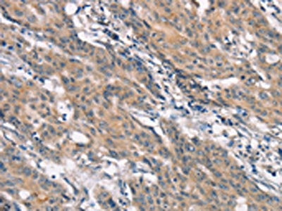The image on the left is immunohistochemistry of paraffin-embedded Human gastric cancer tissue using CRKL Antibody(CRKL Antibody) at dilution 1/25, on the right is treated with synthetic peptide. (Original magnification: ×200)Rabbit anti-Human CRKL Polyclonal Antibody