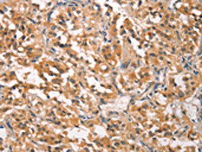 The image on the left is immunohistochemistry of paraffin-embedded Human thyroid cancer tissue using the antibody Antibody) at dilution 1/25, on the right is treated with synthetic peptide. (Original magnification: ×200)Rabbit anti-Human CRKL Polyclonal Antibody