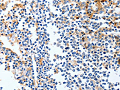The image on the left is immunohistochemistry of paraffin-embedded Human tonsil tissue using LRP1 Antibody(LRP1  Antibody) at dilution 1/90, on the right is treated with synthetic peptide. (Original magnification: ×200)