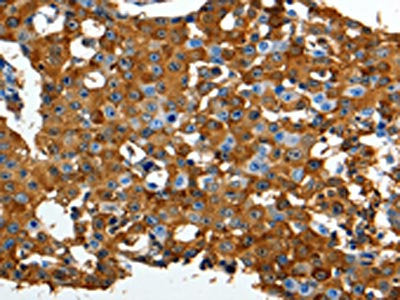 The image on the left is immunohistochemistry of paraffin-embedded Human breast cancer tissue using the antibody  Antibody) at dilution 1/90, on the right is treated with synthetic peptide. (Original magnification: ×200)