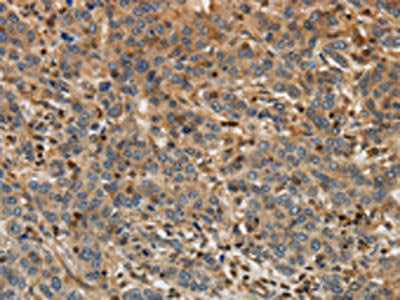 The image on the left is immunohistochemistry of paraffin-embedded Human liver cancer tissue using the antibody Antibody) at dilution 1/30, on the right is treated with synthetic peptide. (Original magnification: ×200)Rabbit anti-Human ARF6 Polyclonal Antibody