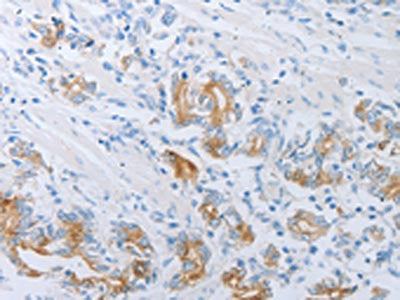 The image on the left is immunohistochemistry of paraffin-embedded Human gastric cancer tissue using LOX Antibody(LOX Antibody) at dilution 1/30, on the right is treated with synthetic peptide. (Original magnification: ×200)