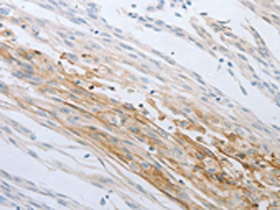 The image on the left is immunohistochemistry of paraffin-embedded Human cervical cancer tissue using the antibody Antibody) at dilution 1/30, on the right is treated with synthetic peptide. (Original magnification: ×200)