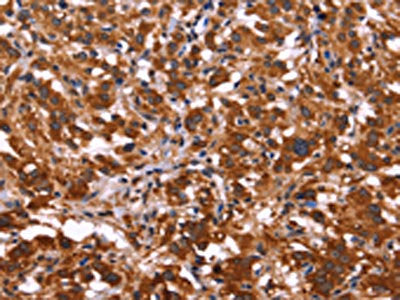 The image on the left is immunohistochemistry of paraffin-embedded Human thyroid cancer tissue using the antibody Antibody) at dilution 1/50, on the right is treated with fusion protein. (Original magnification: ×200)Rabbit anti-Human ARL4A Polyclonal Antibody