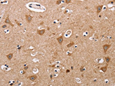 The image on the left is immunohistochemistry of paraffin-embedded Human thyroid cancer tissue using ALG9 Antibody(ALG9 Antibody) at dilution 1/60, on the right is treated with fusion protein. (Original magnification: ×200)Rabbit anti-Human ALG9 Polyclonal Antibody