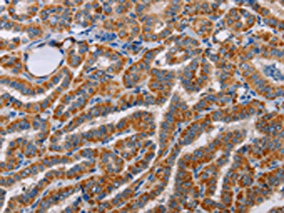 The image on the left is immunohistochemistry of paraffin-embedded Human brain tissue using the antibody Antibody) at dilution 1/60, on the right is treated with fusion protein. (Original magnification: ×200)Rabbit anti-Human ALG9 Polyclonal Antibody