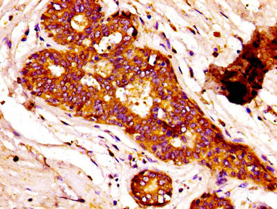 IHC image of the antibody diluted at 1:100 and staining in paraffin-embedded human breast cancer performed on a Leica BondTM system. After dewaxing and hydration, antigen retrieval was mediated by high pressure in a citrate buffer (pH 6.0). Section was blocked with 10% normal goat serum 30min at RT. Then primary antibody (1% BSA) was incubated at 4°C overnight. The primary is detected by a biotinylated secondary antibody and visualized using an HRP conjugated SP system.Rabbit anti-Human FASN Polyclonal Antibody
