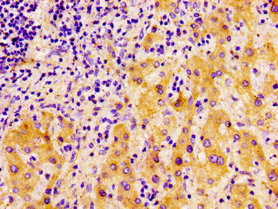 IHC image of FASN Antibody diluted at 1:100 and staining in paraffin-embedded human liver cancer performed on a Leica BondTM system. After dewaxing and hydration, antigen retrieval was mediated by high pressure in a citrate buffer (pH 6.0). Section was blocked with 10% normal goat serum 30min at RT. Then primary antibody (1% BSA) was incubated at 4°C overnight. The primary is detected by a biotinylated secondary antibody and visualized using an HRP conjugated ABC system.Rabbit anti-Human FASN Polyclonal Antibody