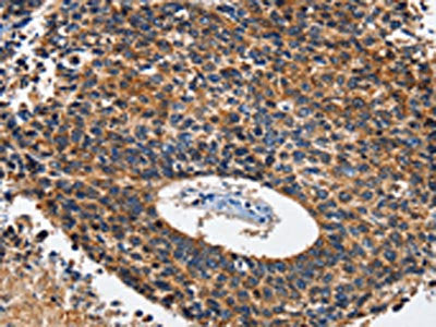 The image on the left is immunohistochemistry of paraffin-embedded Human lung cancer tissue using HK2 Antibody(HK2 Antibody) at dilution 1/60, on the right is treated with fusion protein. (Original magnification: X200)Rabbit anti-Human HK2 Polyclonal Antibody