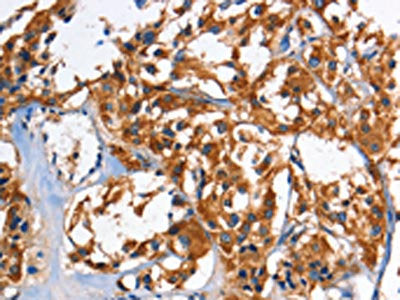 The image on the left is immunohistochemistry of paraffin-embedded Human thyroid cancer tissue using the antibody Antibody) at dilution 1/60, on the right is treated with fusion protein. (Original magnification: X200)Rabbit anti-Human HK2 Polyclonal Antibody