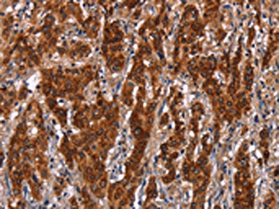 The image on the left is immunohistochemistry of paraffin-embedded Human gastric cancer tissue using GCKR Antibody(GCKR Antibody) at dilution 1/50, on the right is treated with synthetic peptide. (Original magnification: ×200)Rabbit anti-Human GCKR Polyclonal Antibody