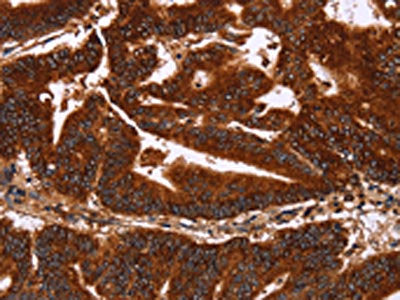The image on the left is immunohistochemistry of paraffin-embedded Human colon cancer tissue using the antibody Antibody) at dilution 1/50, on the right is treated with synthetic peptide. (Original magnification: ×200)Rabbit anti-Human GCKR Polyclonal Antibody