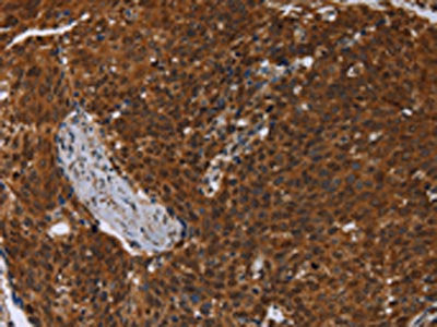 The image on the left is immunohistochemistry of paraffin-embedded Human cervical cancer tissue using MCHR1 Antibody(MCHR1 Antibody) at dilution 1/30, on the right is treated with synthetic peptide. (Original magnification: ×200)