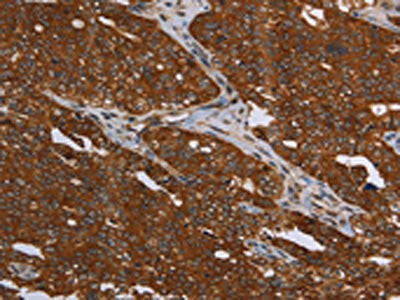 The image on the left is immunohistochemistry of paraffin-embedded Human ovarian cancer tissue using the antibody Antibody) at dilution 1/30, on the right is treated with synthetic peptide. (Original magnification: ×200)