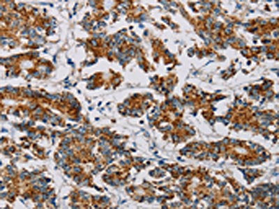 The image on the left is immunohistochemistry of paraffin-embedded Human colon cancer tissue using MTFP1 Antibody(MTFP1 Antibody) at dilution 1/20, on the right is treated with fusion protein. (Original magnification: ×200)Rabbit anti-Human MTFP1 Polyclonal Antibody