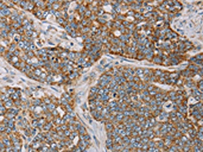 The image on the left is immunohistochemistry of paraffin-embedded Human cervical cancer tissue using the antibody Antibody) at dilution 1/20, on the right is treated with fusion protein. (Original magnification: ×200)Rabbit anti-Human MTFP1 Polyclonal Antibody