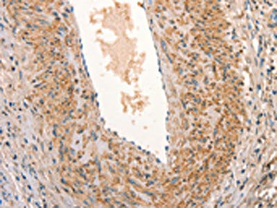 The image on the left is immunohistochemistry of paraffin-embedded Human cervical cancer tissue using ARFRP1 Antibody(ARFRP1 Antibody) at dilution 1/25, on the right is treated with synthetic peptide. (Original magnification: ×200)Rabbit anti-Human ARFRP1 Polyclonal Antibody