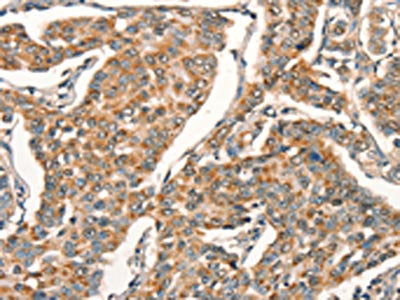 The image on the left is immunohistochemistry of paraffin-embedded Human breast cancer tissue using the antibody Antibody) at dilution 1/25, on the right is treated with synthetic peptide. (Original magnification: ×200)Rabbit anti-Human ARFRP1 Polyclonal Antibody