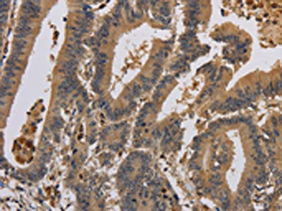 The image on the left is immunohistochemistry of paraffin-embedded Human colon cancer tissue using KCNA7 Antibody(KCNA7 Antibody) at dilution 1/40, on the right is treated with synthetic peptide. (Original magnification: ×200)