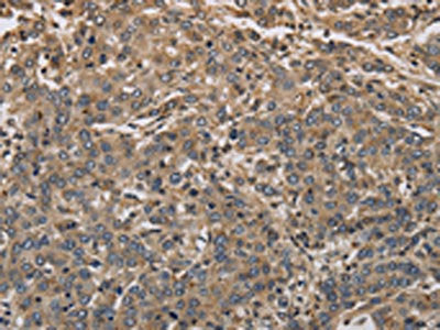 The image on the left is immunohistochemistry of paraffin-embedded Human liver cancer tissue using the antibody Antibody) at dilution 1/40, on the right is treated with synthetic peptide. (Original magnification: ×200)