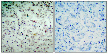 Immunohistochemical analysis of paraffin-embedded human breast carcinoma tissue using Rb(Phospho-Ser780) Antibody(left) or the same antibody preincubated with blocking peptide(right).Rabbit anti-Human RB1 Polyclonal Antibody