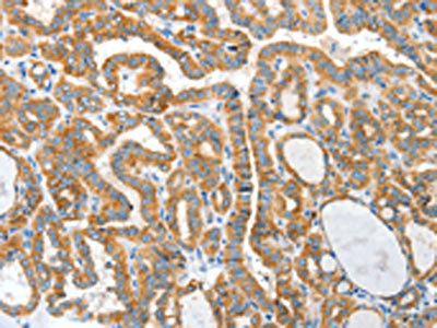 The image on the left is immunohistochemistry of paraffin-embedded Human thyroid cancer tissue using CKAP4 Antibody(CKAP4 Antibody) at dilution 1/50, on the right is treated with synthetic peptide. (Original magnification: ×200)Rabbit anti-Human CKAP4 Polyclonal Antibody