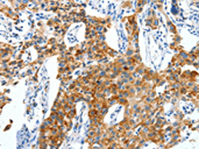 The image on the left is immunohistochemistry of paraffin-embedded Human lung cancer tissue using the antibody Antibody) at dilution 1/50, on the right is treated with synthetic peptide. (Original magnification: ×200)Rabbit anti-Human CKAP4 Polyclonal Antibody