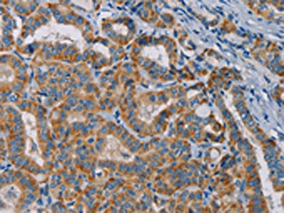 The image is immunohistochemistry of paraffin-embedded Human thyroid cancer tissue using the antibody Antibody) at dilution 1/25. (Original magnification: ×200)Rabbit anti-Human TAB3 Polyclonal Antibody